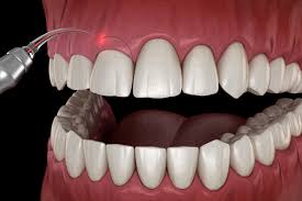 Gum/Gingival Surgery
