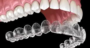 ALIGNERS