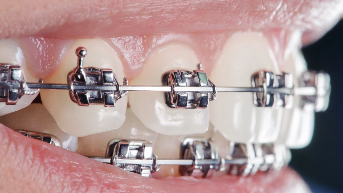Orthodontic Treatment (braces)