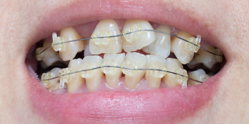 Treatment for Broken and Uneven Teeth